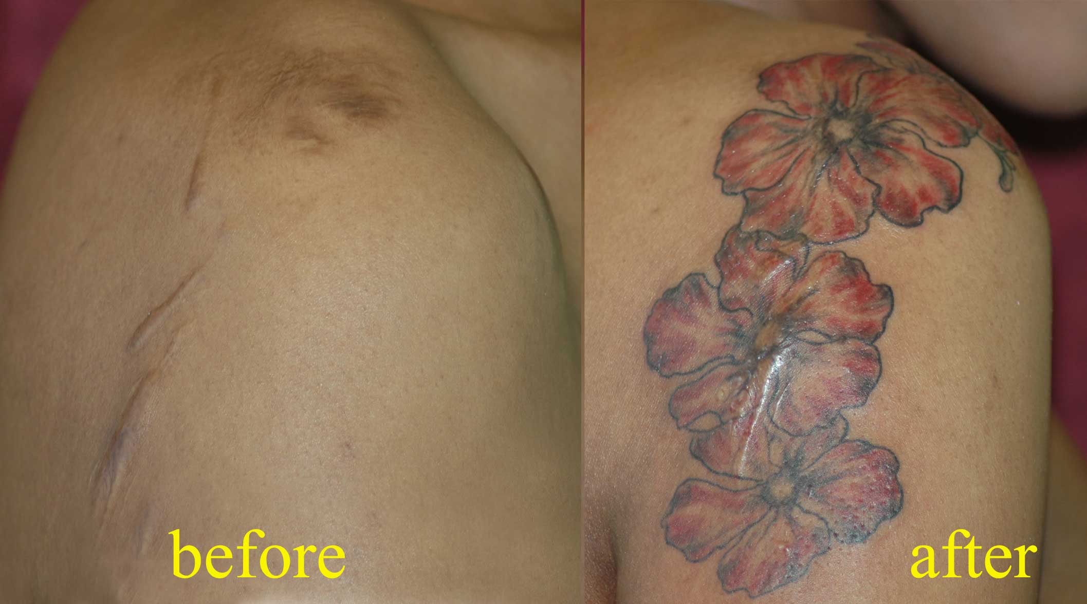 Tattoo-καλυψης-ουλών-ediva.gr-gr-3
