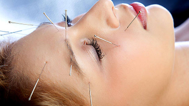 acupuncture_iStock_00001447